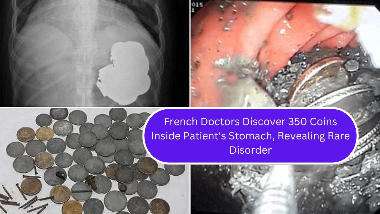 French Doctors Discover 350 Coins Inside Patient's Stomach, Revealing Rare Disorder